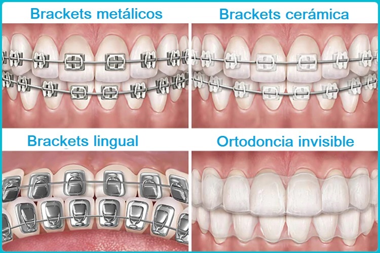 Mejora tu sonrisa con la nueva ortodoncia invisible